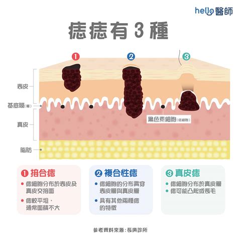 痣變大變凸|痣形成的原因？痣長毛、痣變多變大是痣病變？5招判。